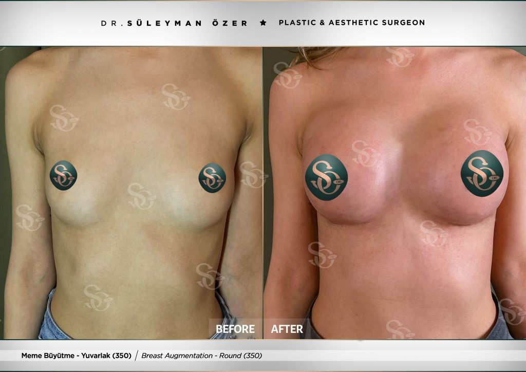 Before & After 29 Before and after breast augmentation with 350 cc round implants