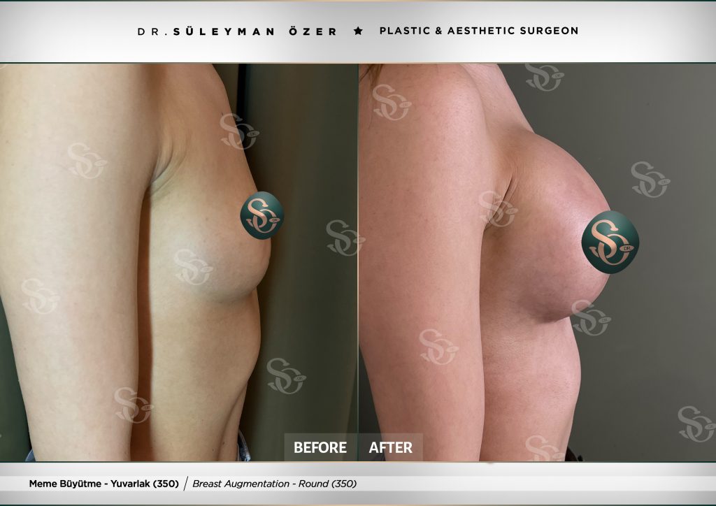 Before & After 31 Before and after breast augmentation with 350 cc round implants
