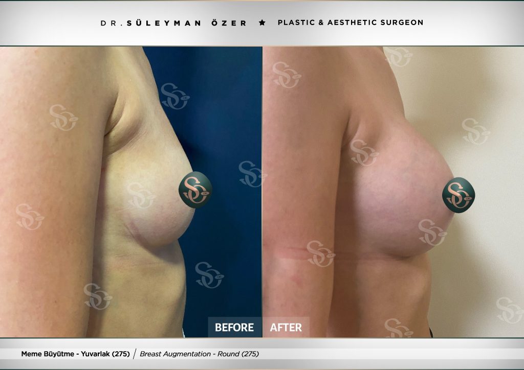 Öncesi ve Sonrası 20 275 cc yuvarlak implant ile meme büyütme öncesi ve sonrası