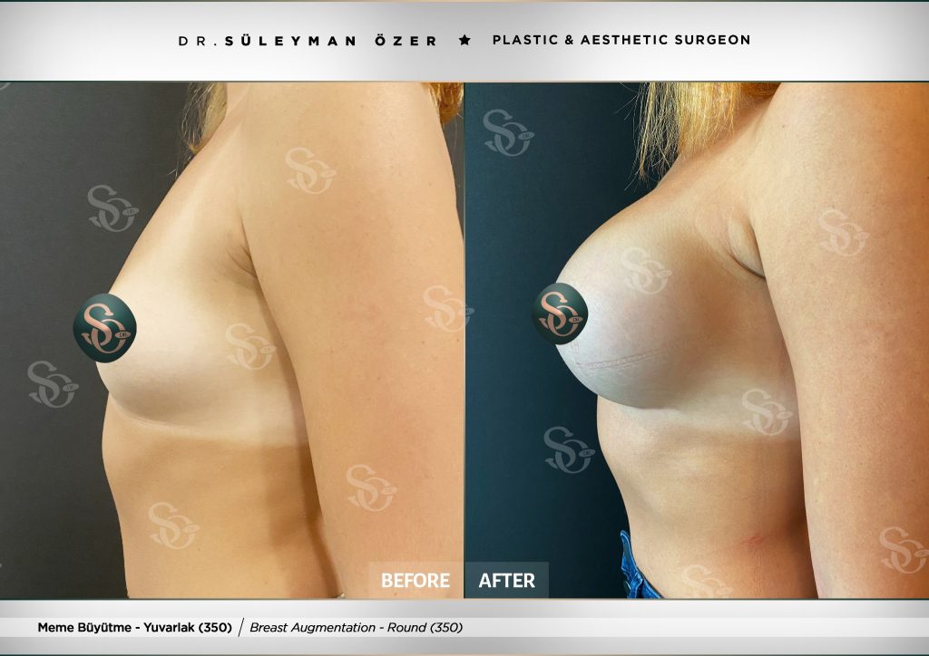 Öncesi ve Sonrası 27 350 cc yuvarlak implant ile meme büyütme öncesi ve sonrası