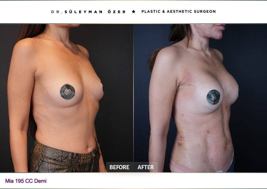 Oblique before and after Mia Femtech breast augmentation with 190 cc full implants