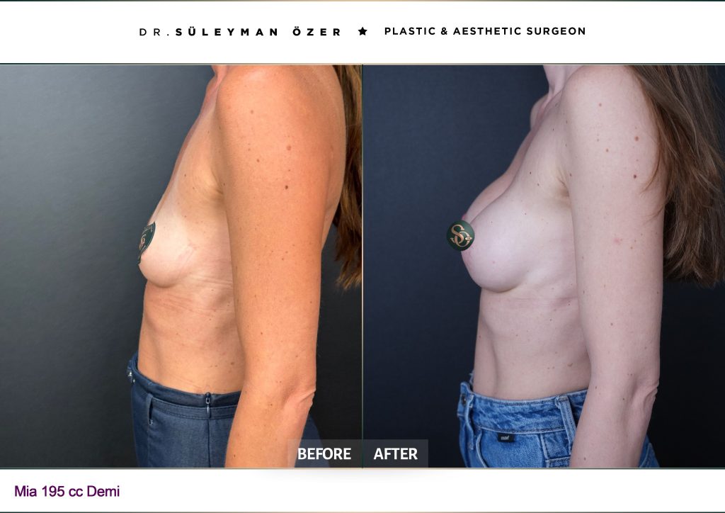 Front before and after Mia Femtech breast augmentation with 195 cc demi implants