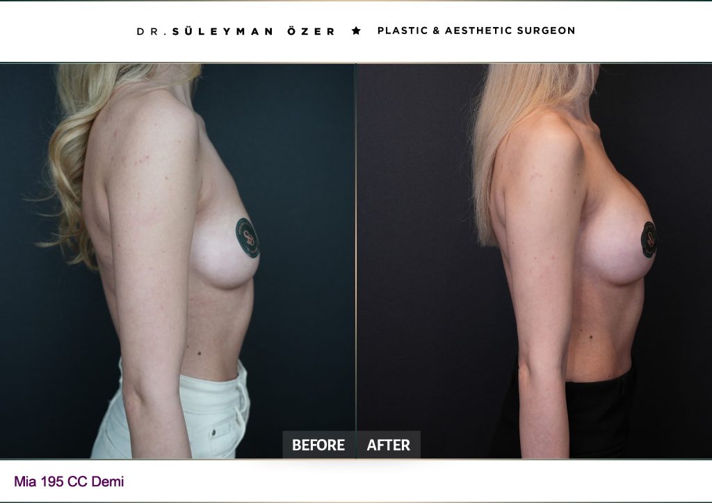 Front before and after Mia Femtech breast augmentation with 195 cc demi implants