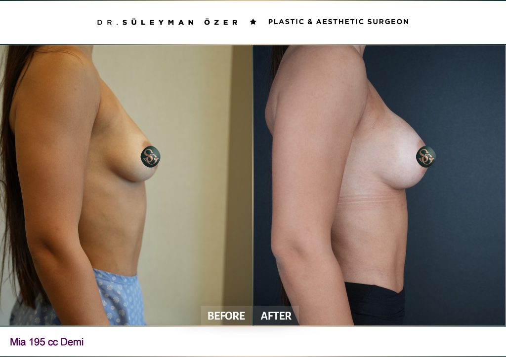 Front before and after Mia Femtech breast augmentation with 195 cc demi implants