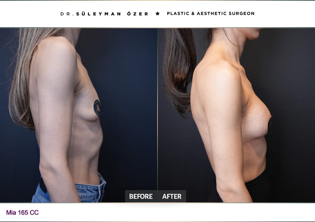 Oblique before and after Mia Femtech breast augmentation with 195 cc demi implants
