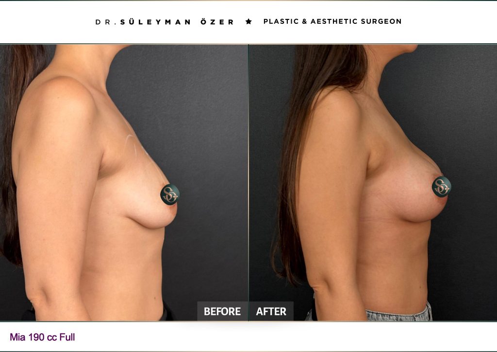 Oblique before and after Mia Femtech breast augmentation with 195 cc demi implants