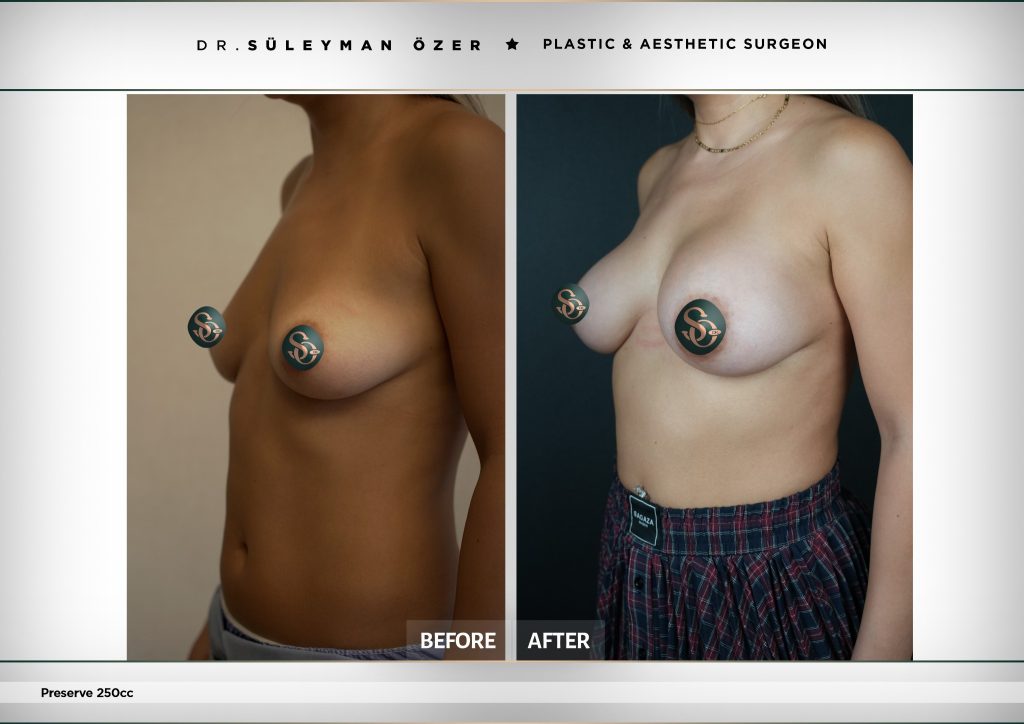 Before and after Preservé breast augmentation with 250 cc implants