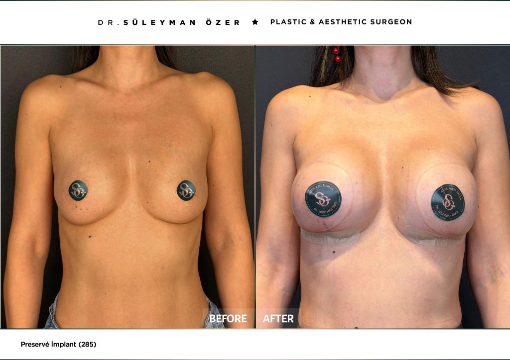 Before and after Preservé breast augmentation with 285 cc implants