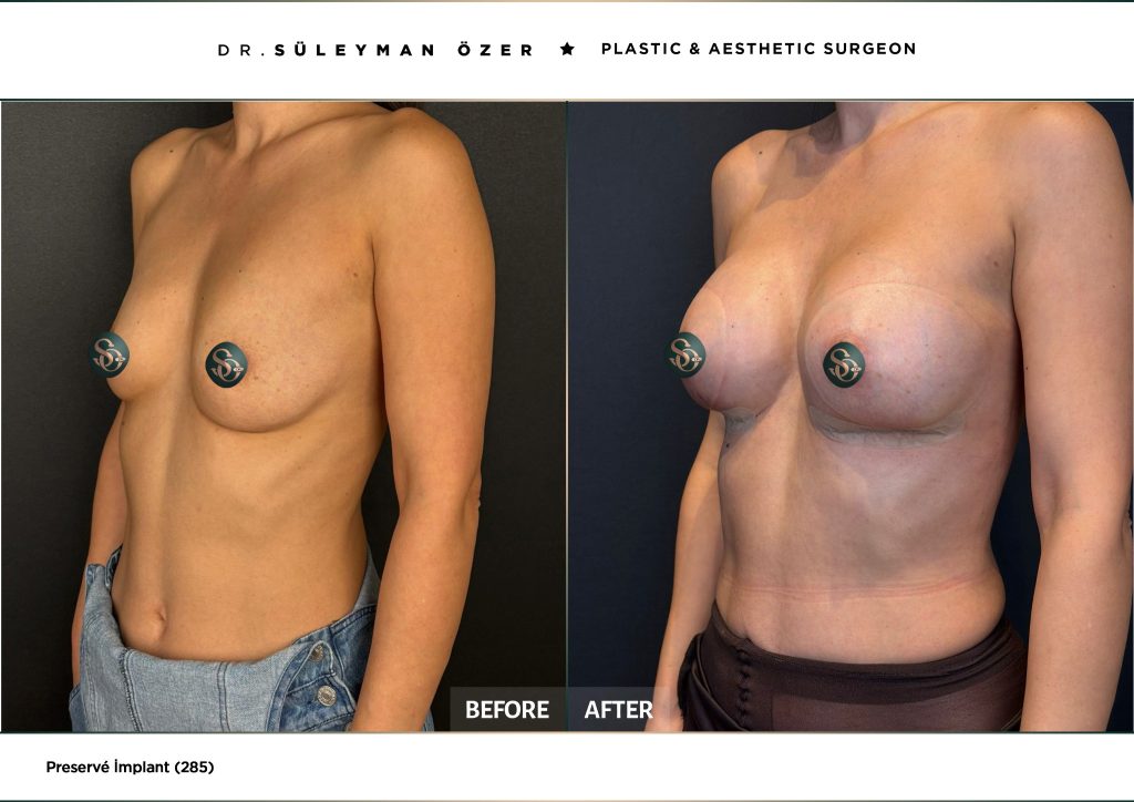 Before and after Preservé breast augmentation with 285 cc implants