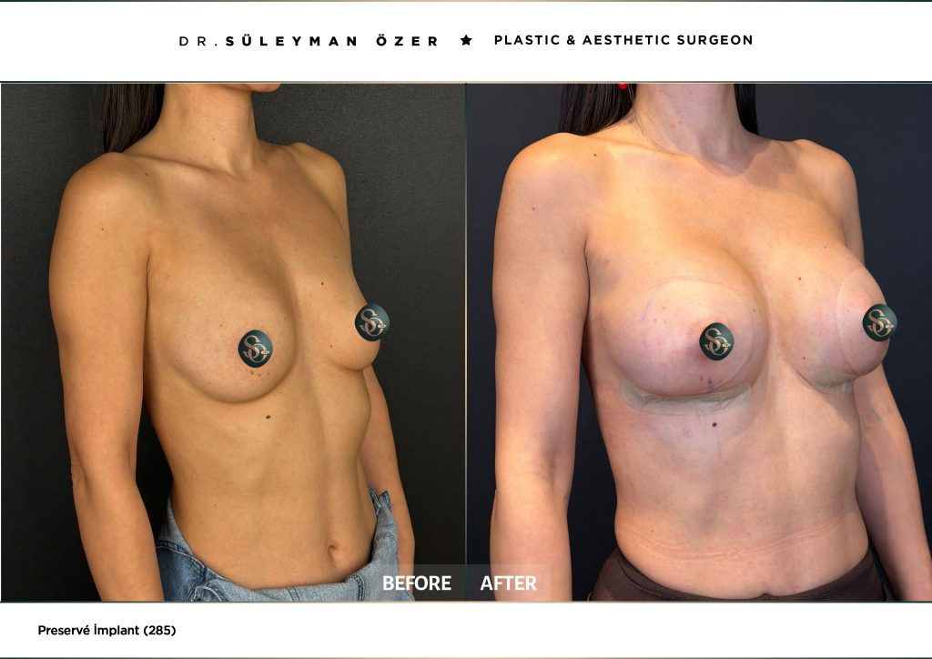Before and after Preservé breast augmentation with 285 cc implants