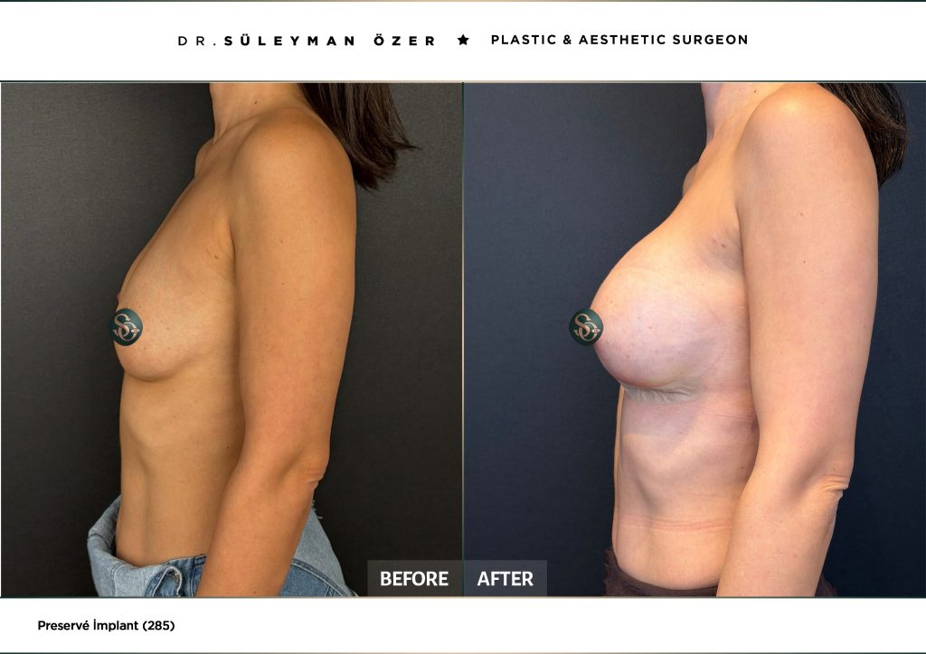 Before and after Preservé breast augmentation with 285 cc implants