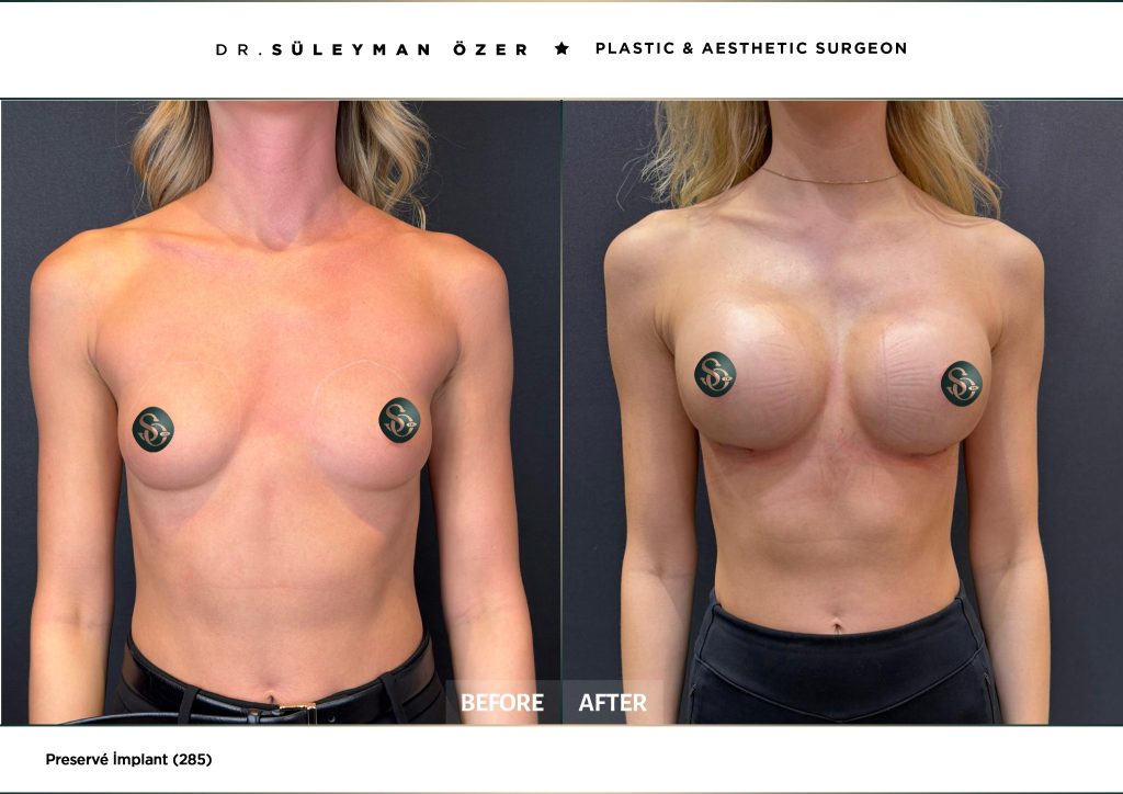 Before and after Preservé breast augmentation with 285 cc demi implants