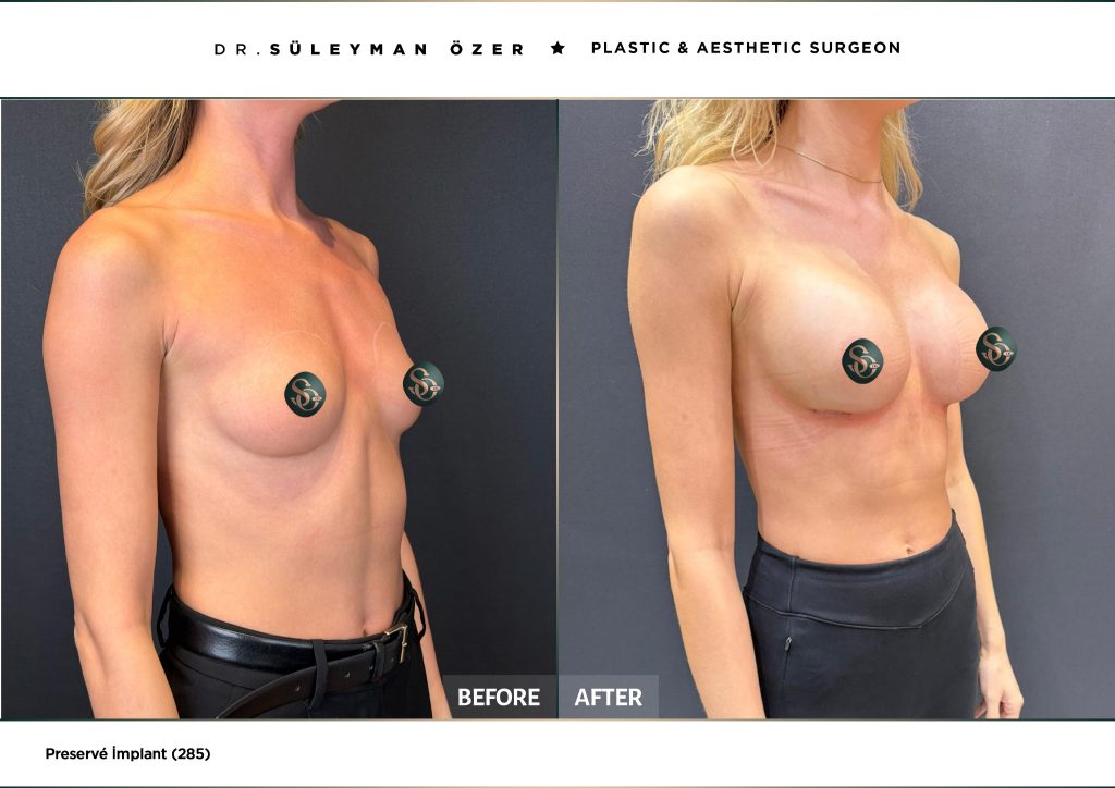 Before and after Preservé breast augmentation with 285 cc demi implants