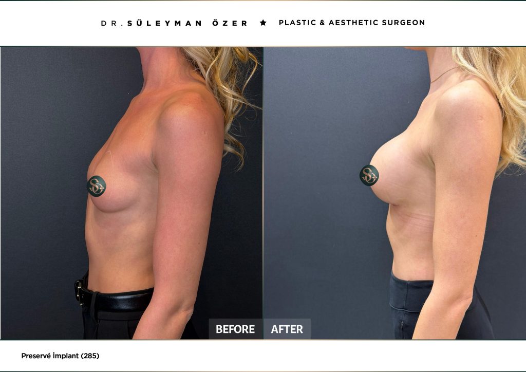 Before and after Preservé breast augmentation with 285 cc demi implants