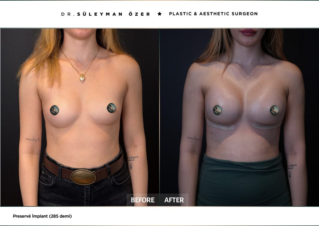Before and after Preservé breast augmentation with 285 cc demi implants