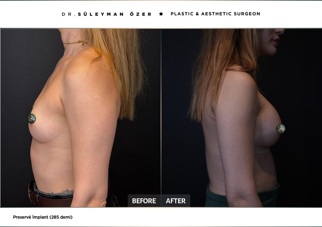 Before and after Preservé breast augmentation with 285 cc demi implants
