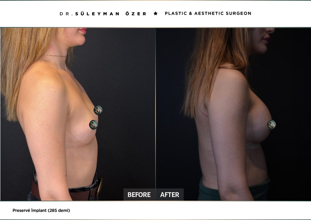 Before and after Preservé breast augmentation with 285 cc demi implants