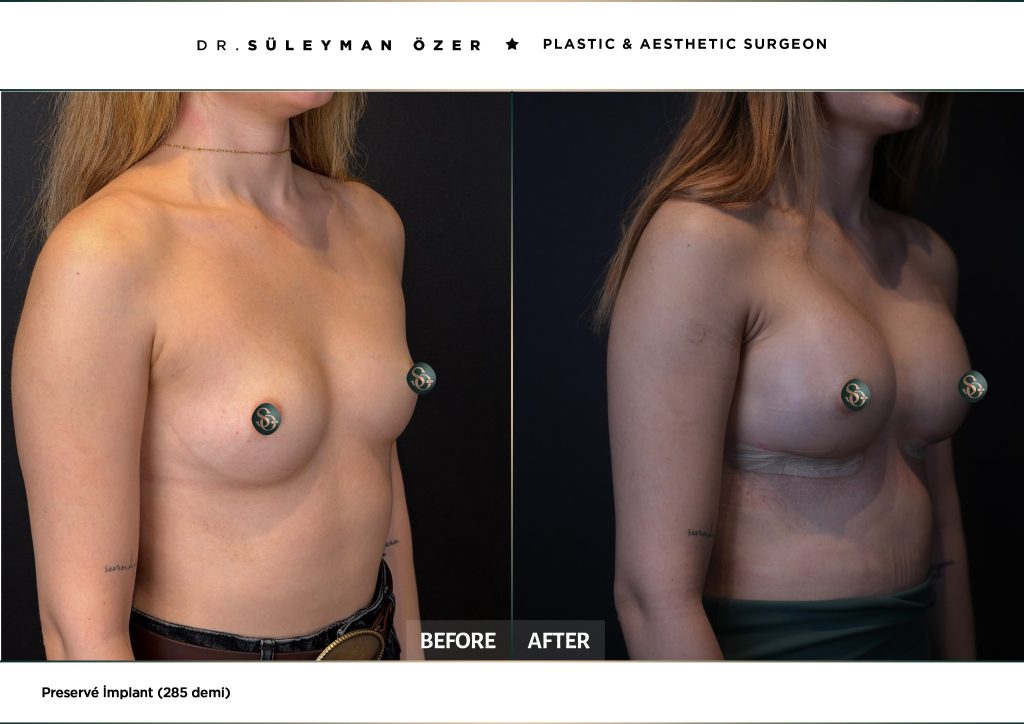 Before and after Preservé breast augmentation with 285 cc demi implants