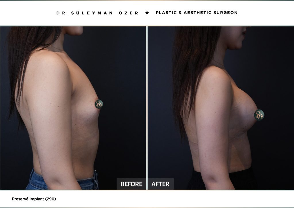 290 cc Preservé meme büyütme öncesi ve sonrası