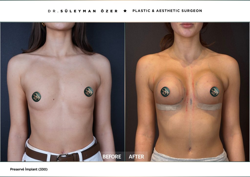 330 cc Preservé meme büyütme öncesi ve sonrası