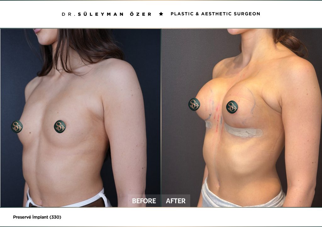 330 cc Preservé meme büyütme öncesi ve sonrası