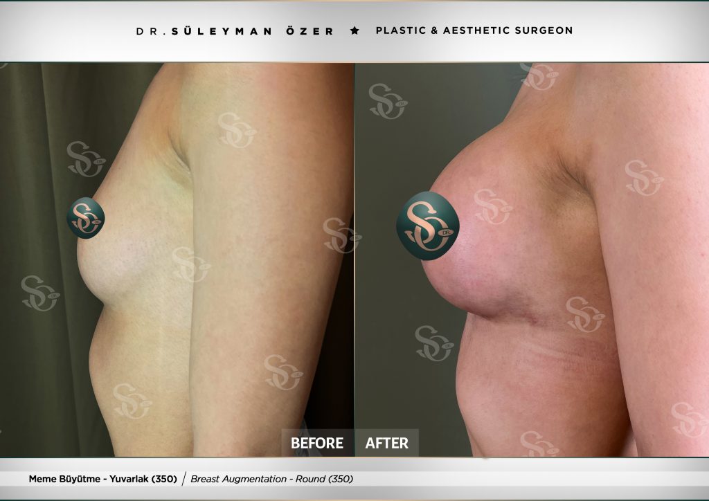 Before and after breast augmentation with 350 cc round implants