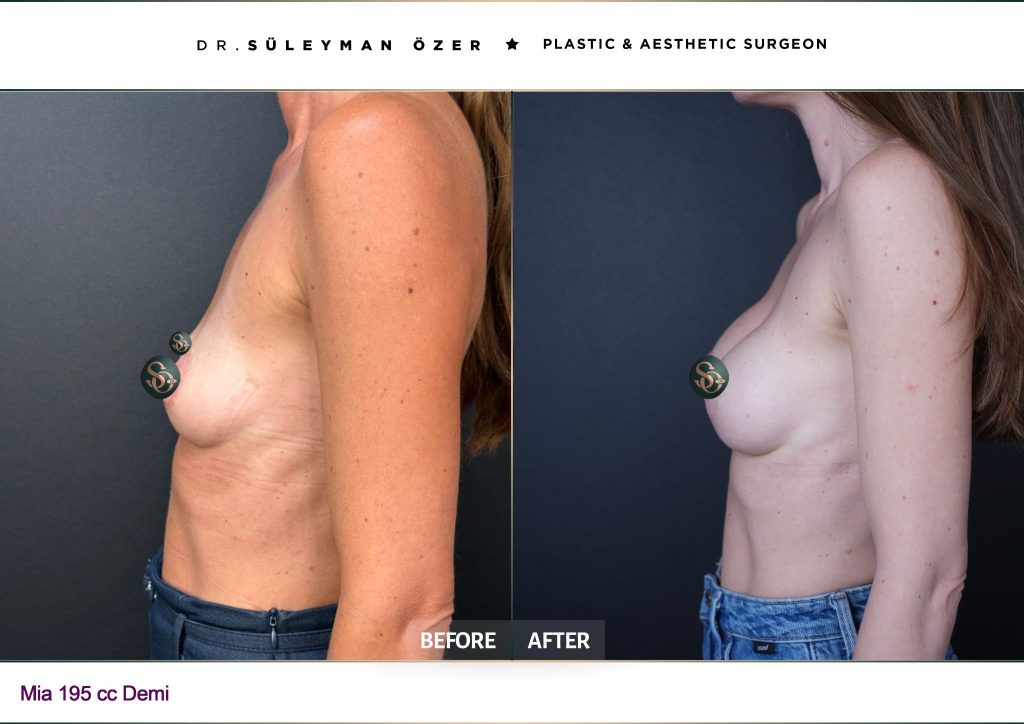 Front before and after Mia Femtech breast augmentation with 165 cc implants