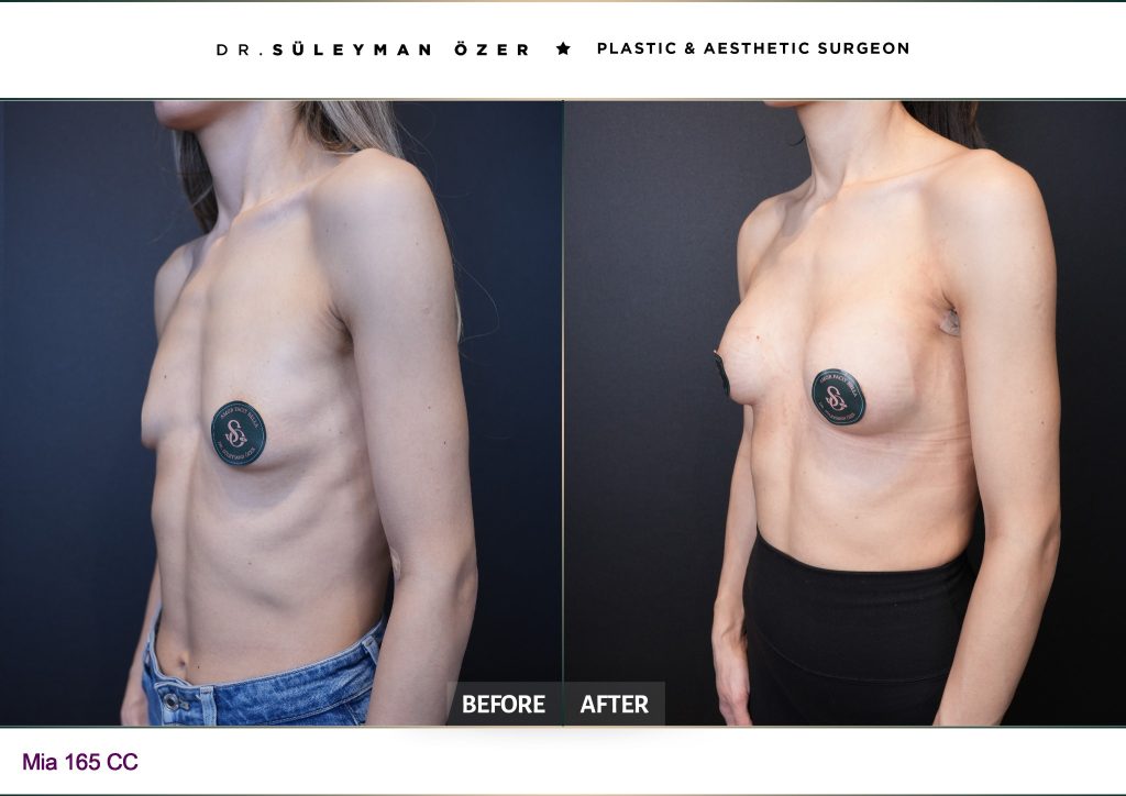 Oblique before and after Mia Femtech breast augmentation with 165 cc implants