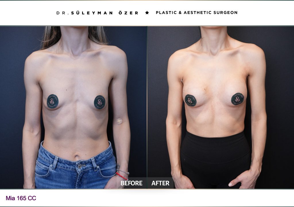 Side before and after Mia Femtech breast augmentation with 165 cc implants