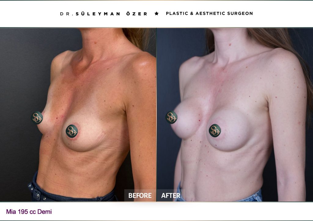 Side before and after Mia Femtech breast augmentation with 165 cc implants
