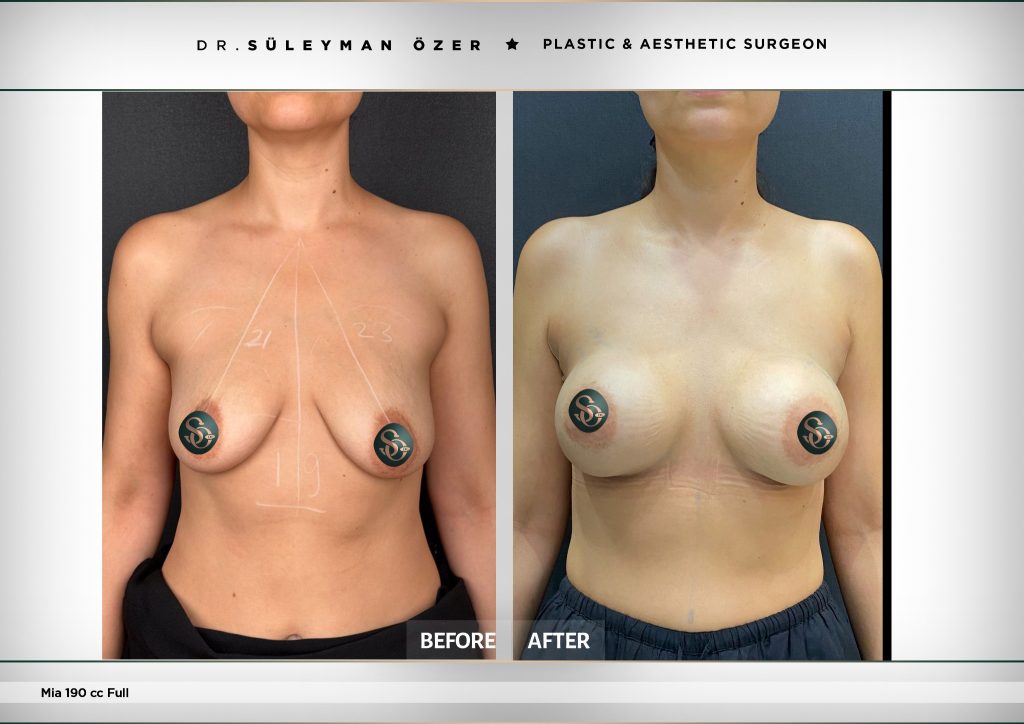 Front view before and after MIA Femtech breast augmentation with 190 cc full-profile implants