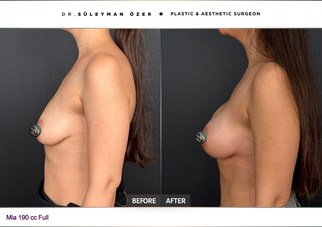 Oblique before and after Mia Femtech breast augmentation with 190 cc full implants