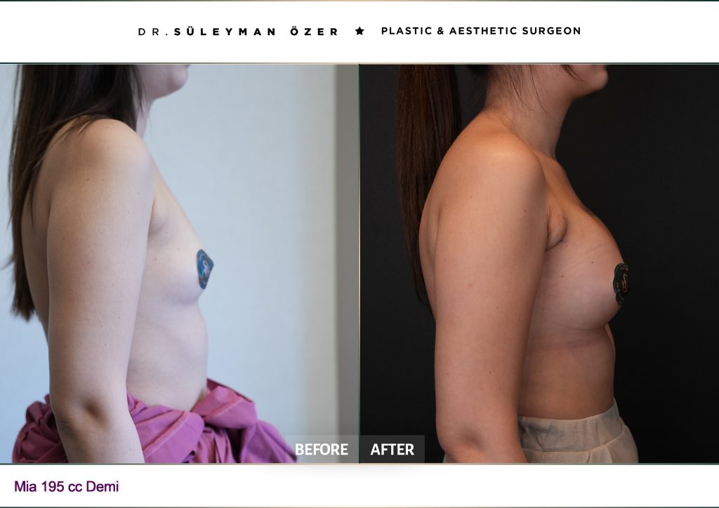 195 cc demi implant ile Mia Femtech meme büyütme öncesi ve sonrası çapraz görünüm