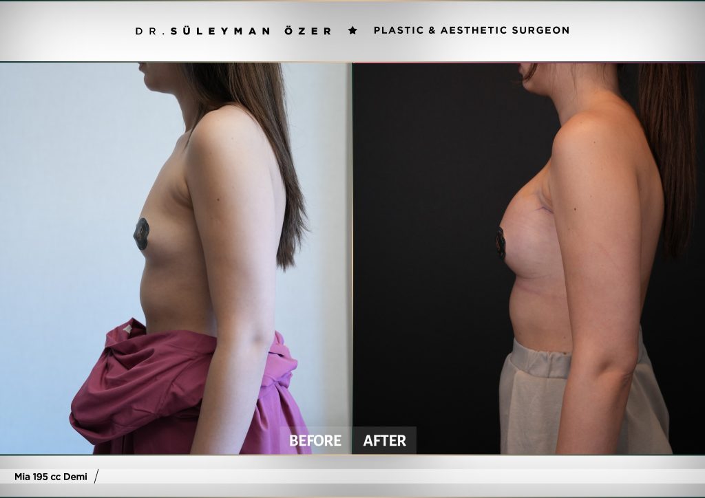 195 cc demi implant ile Mia Femtech meme büyütme öncesi ve sonrası çapraz görünüm