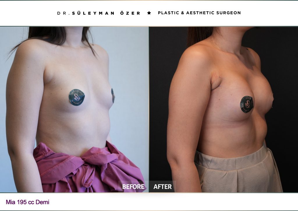 195 cc demi implant ile Mia Femtech meme büyütme öncesi ve sonrası çapraz görünüm