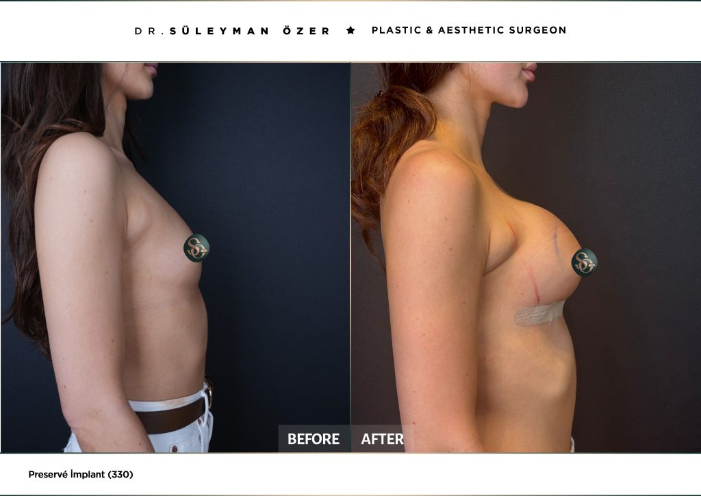 330 cc Preservé meme büyütme öncesi ve sonrası